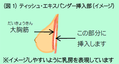 (図1) ティッシュ・エキスパンダー挿入部(イメージ)