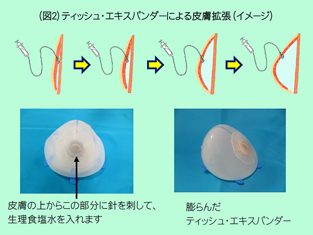 (図2)ティッシュ・エキスパンダーによる皮膚拡張(イメージ)