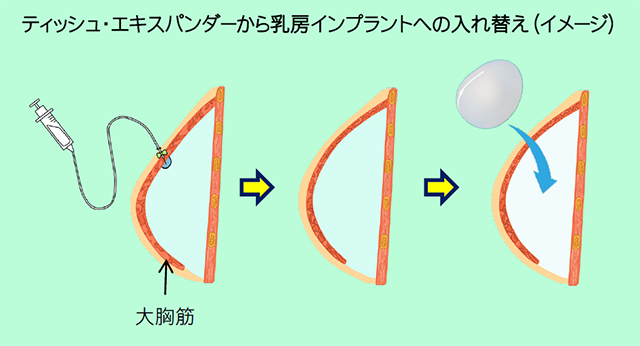 ティッシュ・エキスパンダーから乳房インプラントへの入れ替え(イメージ)